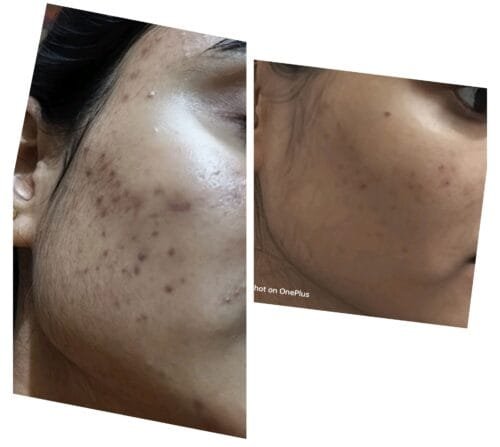 Anti Pigmentation Combo by Tatved Herbal photo review