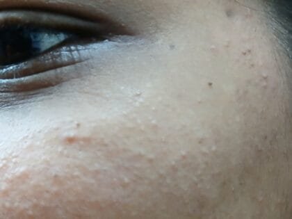 Anti Pigmentation Combo by Tatved Herbal photo review