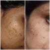Anti Pigmentation Combo by Tatved Herbal