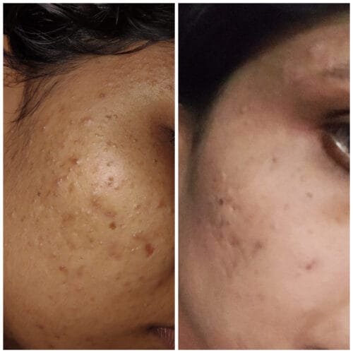Anti Pigmentation Combo by Tatved Herbal photo review