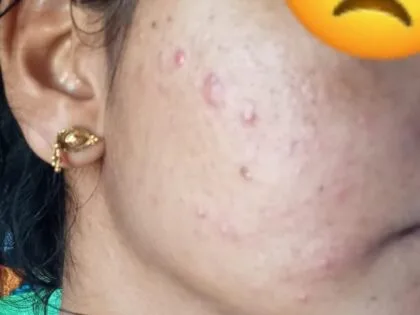 Sensitive skin saviour kit by Tatved Herbal photo review