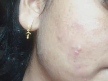 Sensitive skin saviour kit by Tatved Herbal photo review