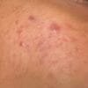 Anti Pigmentation Combo by Tatved Herbal