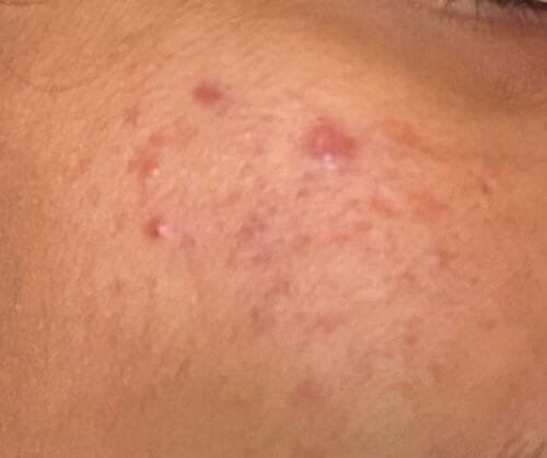 Anti Pigmentation Combo by Tatved Herbal photo review