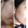Anti Pigmentation Combo by Tatved Herbal
