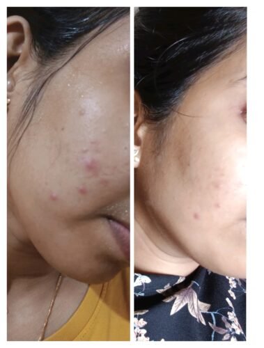 Anti Pigmentation Combo by Tatved Herbal photo review